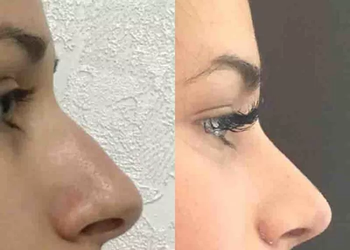 Нос в своем деле или все, что нужно знать о ринопластике - 5 - изображение