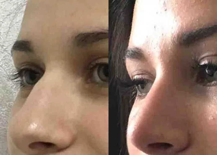 Нос в своем деле или все, что нужно знать о ринопластике - 4 - изображение