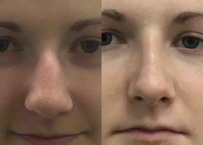 Нос в своем деле или все, что нужно знать о ринопластике - 3 - изображение