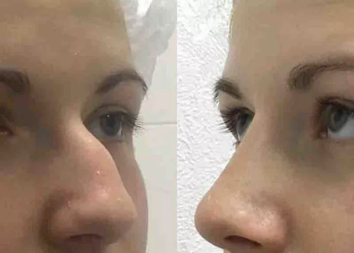 Нос в своем деле или все, что нужно знать о ринопластике - 2 - изображение